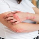 Dermatitis atopica