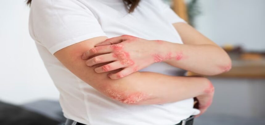 Dermatitis atopica